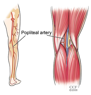 popliteal-artery-entrapment-syndrome-1