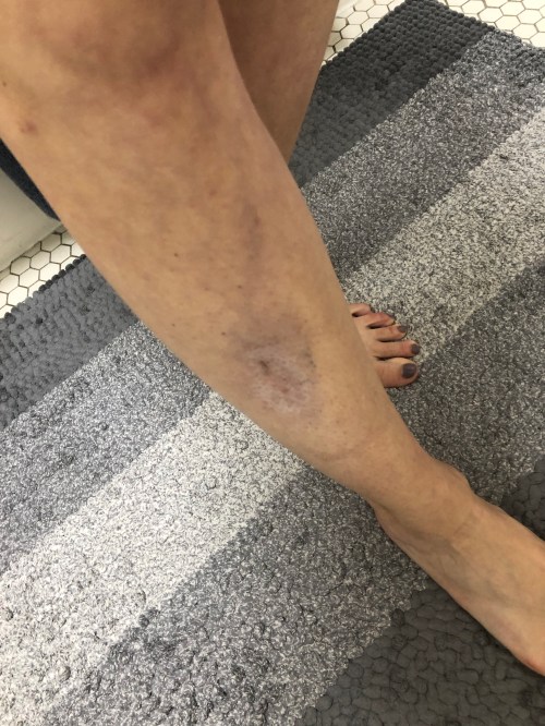 Leg - Black and Blue 1