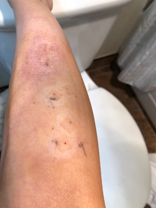 Post Injections Round 3